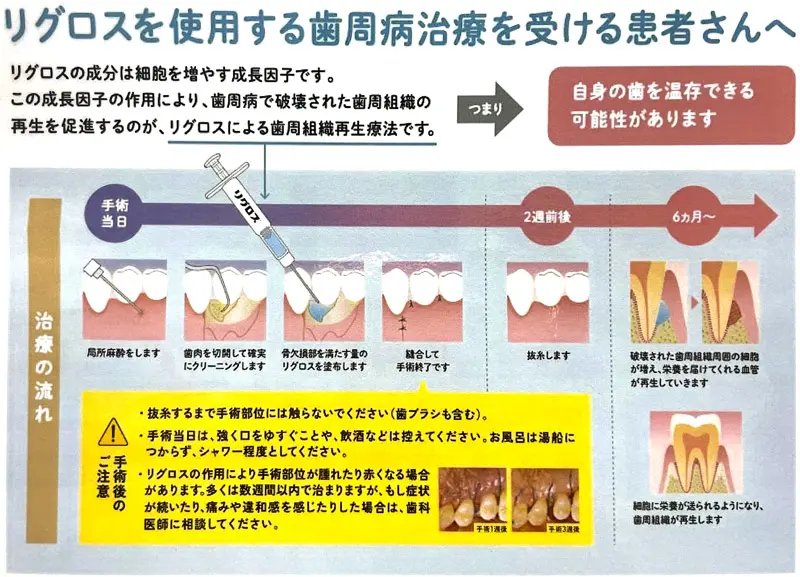 歯周組織再生療法 | 大田区の歯医者 l 矯正歯科・口腔外科ならさとう